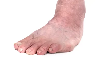 Pacjentka ze skrótem kończyny i stopą końsko-szpotawą