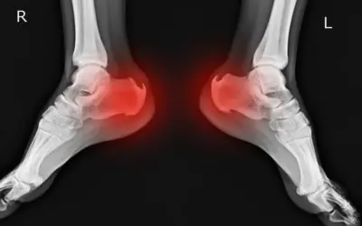 Czy wkładki na ostrogę piętową naprawdę działają?